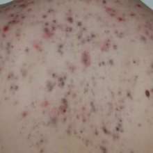 Akne – Ursachen und Behandlung