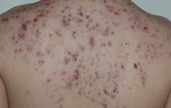 Akne – Ursachen und Behandlung