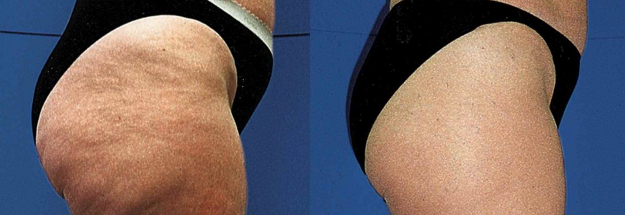 Cellulite – Die Wahrheit über die Orangenhaut