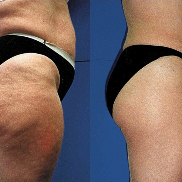 Cellulite – Die Wahrheit über die Orangenhaut