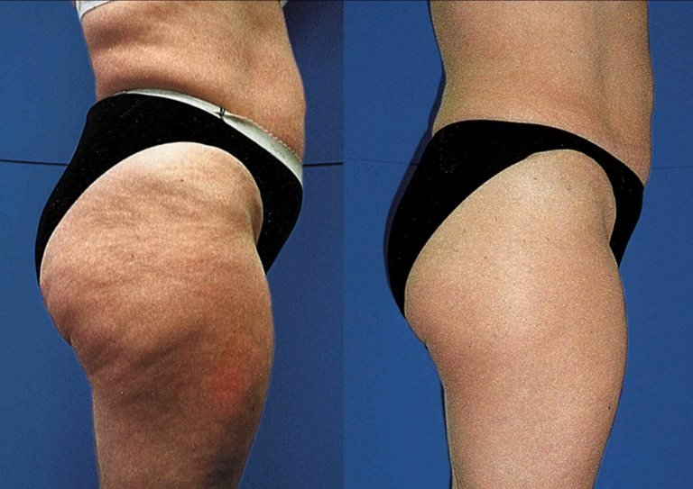 Cellulite – Die Wahrheit über die Orangenhaut